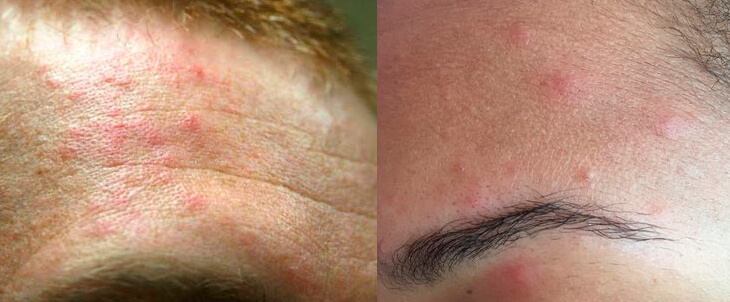 Фото следов укусов клопов на коже головы и лба человека.