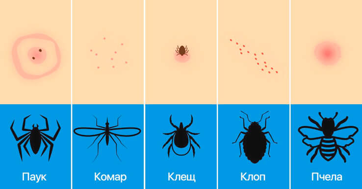 Отличия укусов насекомых