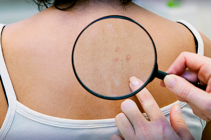 Аллергия на укусы клопов