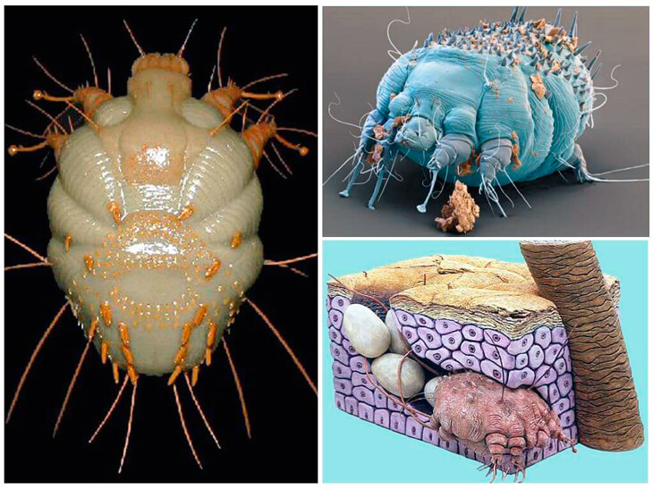 Норвежская чесотка фото.