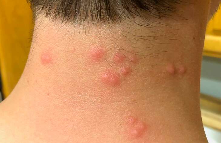 Укусы клопов. Как убрать раздражение и чем лечить. Фото клоповых укусов. Фото укусов клопа на шеи